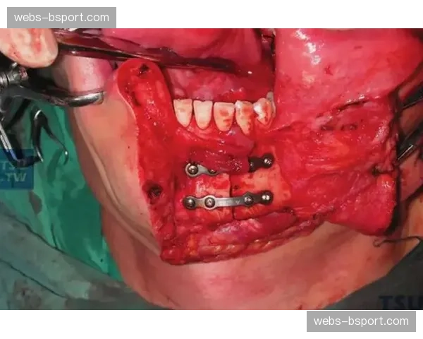 奇克谈2月重伤:被撞掉多颗牙齿下颌骨折,现在感觉好多了 奇克谈2月重伤:被撞掉多颗牙齿下颌骨折,现在感觉好多了